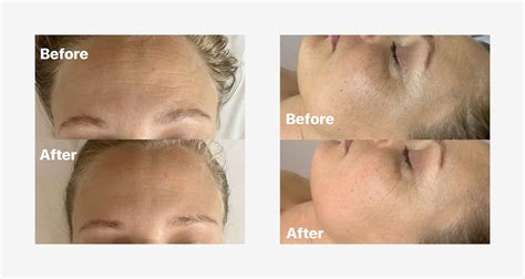 face rolling before and after|face massage roller before after.